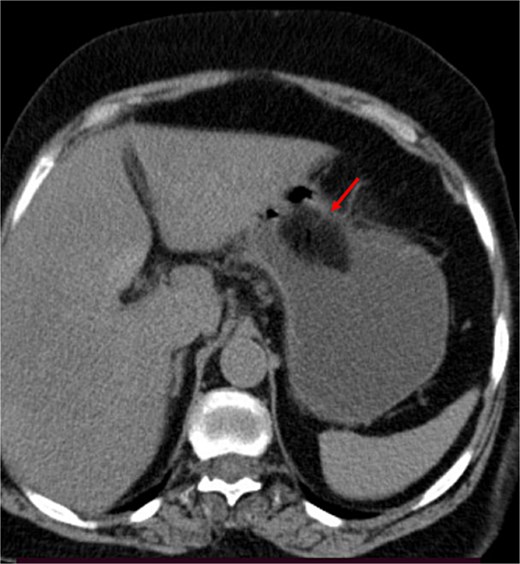 The arrow indicates a gastric-occluding intraluminal mass.