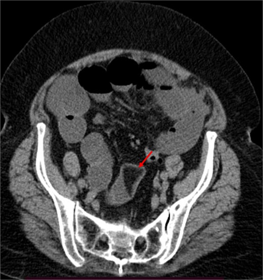 The arrow indicates an intraluminal mass in the small bowel causing proximal small intestinal obstruction.