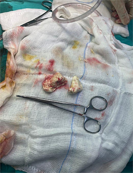 Two foreign bodies were extracted from the stomach and small bowel.