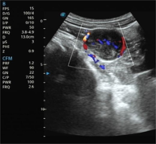 Ultrasonography demonstrates a predominantly hypoechoic mass with peripheral and intralesional blood flow signals.