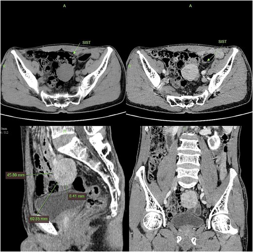 CT imaging shows a pelvic lesion with soft tissue density on non-enhanced scans, marked enhancement of the primary tumor mass after contrast, and coronal/sagittal reconstructions delineating its anatomical location.