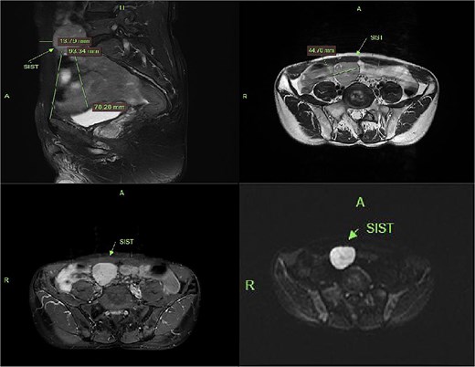 MRI demonstrates superior displacement of the tumor compared to CT, with isointense signal on T2-weighted fat-suppressed sequences, post-contrast enhancement, and hyperintensity on DWI at a b-value of 800 s/mm².