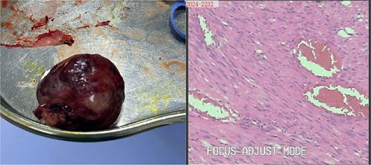 Gross specimen photograph of the laparoscopically resected tumor (right panel) with corresponding histopathological sections (left panel).