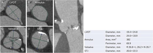 Evaluation of the aortic valve complex using contrast-enhanced CT shows axial views (A–D) and a curved multi-planar reconstruction (E) with a narrowed sinotubular junction and small calcifications (LVOT: left ventricular outflow tract; STJ: sinotubular junction).