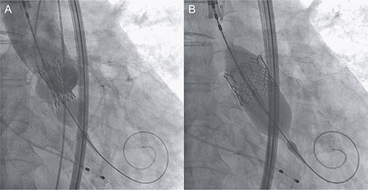 Intraprocedural angiographic images show THV implantation performed with a reduced pressure of −1 cc (A) and post-dilatation conducted with the balloon positioned toward the left ventricular side (B).