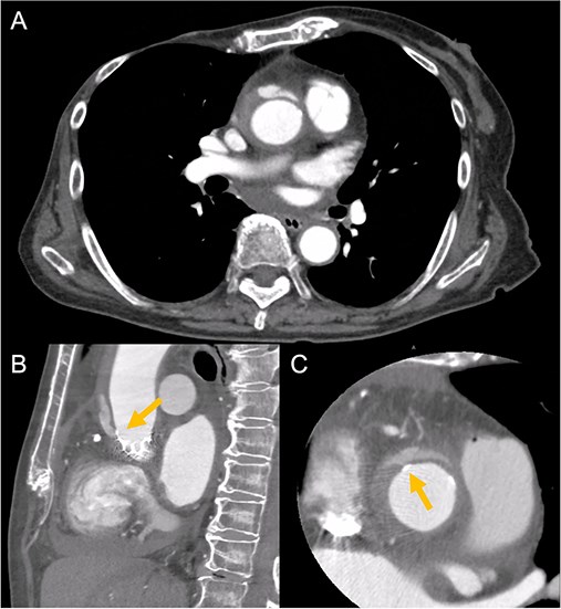 Contrast-enhanced CT on day 7 after discharge shows an AAD in the ascending aorta (A) with the entry point at the STJ extending toward the THV stent frame, suggesting an AAD associated with TAVI (B and C, arrow).