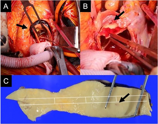 Intraoperative findings show an intramural hematoma above the ostium of the right coronary artery (A, arrow), a pinhole-like intimal defect revealed after removal of the THV and calcified tissue at the STJ (B, arrow), and macroscopic pathological examination of the resected ascending aorta confirming a small intimal defect (C, arrow).
