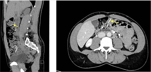 Abdominal CT (03.05.2024), hyperdense foreign body (metallic wire).