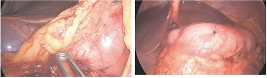 Case 1 intraoperative.