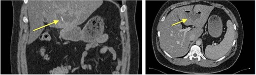 Abdominal CT, hyperdense foreign body (metallic wire).