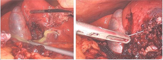 Case 2 intraoperative.