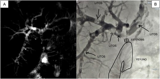(A) MRI showing multiple filling defects in the right and left main branches, as well as stenosis at the level of the HJA; (B) Initial cholangiography obtained by puncturing the peripheral branch of segment VI with a 21-gauge needle confirms the same findings as the MRI.
