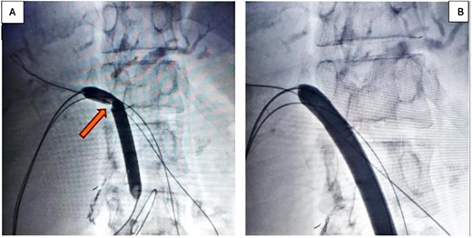 (A) 10 × 60 mm percutaneous balloon fully inflated at the anastomosis level (arrow shows the notch formed at the stenosis level); (B) Projection after performing endoluminal plasty for 3 minutes, maintaining the same inflation pressure.