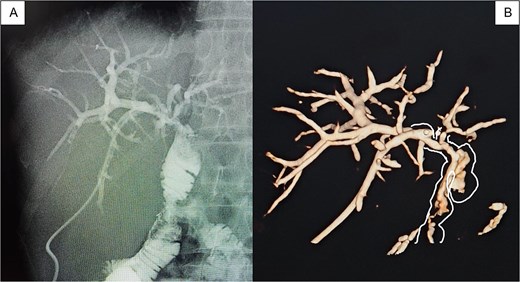 (A) Pre-removal cholangiography of a Nelathon catheter placed in the peripheral branch of segment VI to ensure the path in case of complications, showing fluid passage toward the efferent loop; (B) 3D tomographic reconstruction allows a 360-degree view of the passage of contrast throughout the biliary tree.