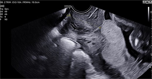 TVU confirming diagnosis of central PP.