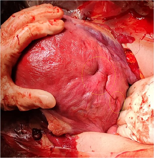 Hemostatic suture with modified Cho stitches on the posterior wall and cervical isthmus.