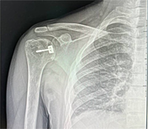 Post-operative CT scan.