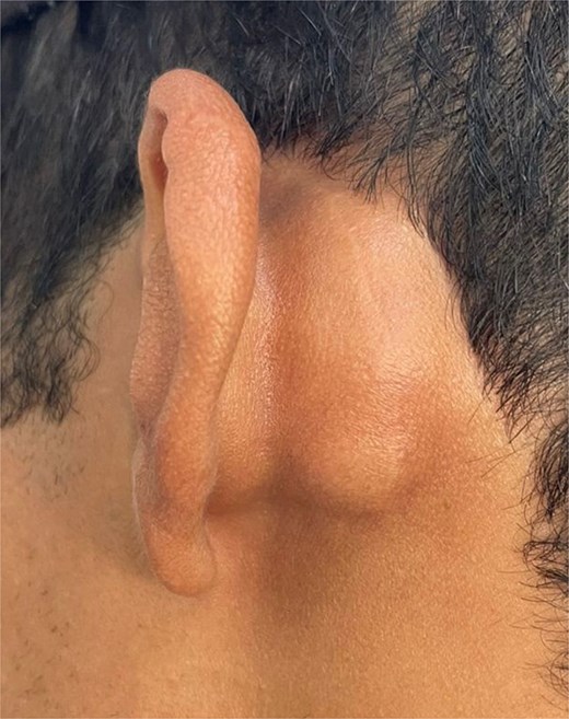 A 3 × 2 cm left postauricular lump, which is cystic and firm on palpation without fluctuation or tenderness after an antibiotic course.