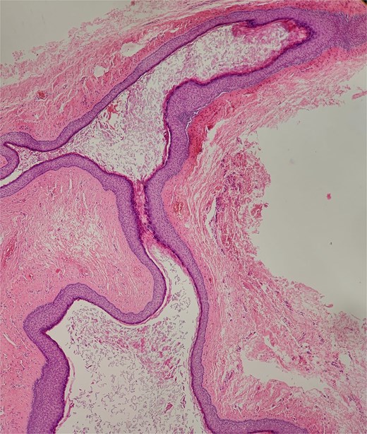 A CT scan reveals a thickened area behind the left ear, indicating the possibility of either a soft tissue abnormality or a cystic lesion.