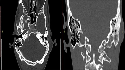 A well-circumscribed cyst lined with stratified squamous epithelium and filled with laminated keratin (hematoxylin and eosin stain, × 40).