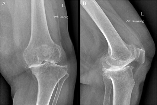 Preoperative face (A) and profile (B) X-rays showing end-stage knee arthritis with varus deformity and severe collision between the medial femoral and tibial condyles.