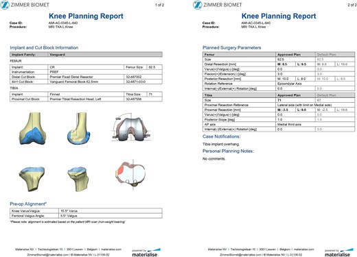 Preoperative plan presenting the medial tibial bone defect (orange color), the varus alignment of the native knee and the proposed femoral ant tibial cuts.