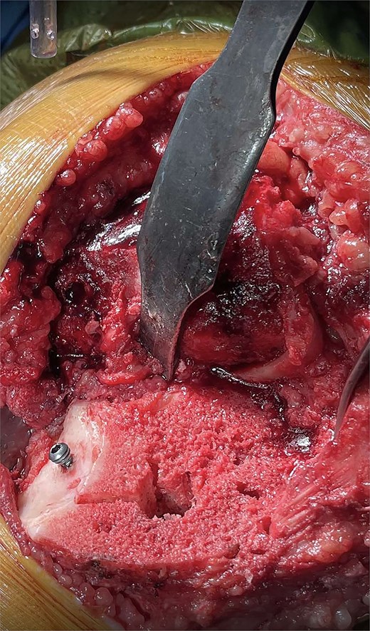 An intraoperative photograph showing the tibia after cuts made with customized 3D-printed guides. The non-contained 9.45 mm tibial bone defect was treated using the BCSA technique. Mechanical stability was ensured by the insertion of a 3.5 mm stainless steel cancellous screw.