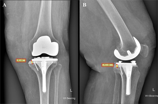 Postoperative face (A) and profile (B) X-rays depicting a medial tibial bone defect ~9.45 mm from the baseplate. The 3.5 mm cancellous screw is indicative of the applied BCSA technique.