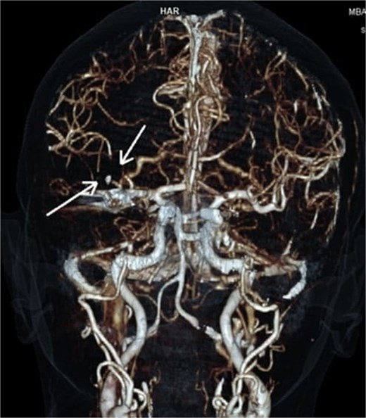 CTA reconstruction indicating proximal occlusion of M2 segmental branches of MCA (arrows).