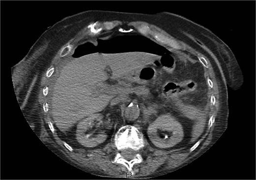 CT image of abdominal free gas.