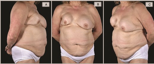 Preoperative evaluation for DIEP flap salvage revealed a contracted, high-riding right breast with a significantly narrowed footprint, lateral midaxillary scar with contour deformity, marked asymmetry in size, shape, and positions of the inframammary folds and nipple-areolar complexes, and severe capsular contracture, while the contralateral left breast also exhibited significant capsular contracture, in a patient with multiple comorbidities including asthma with barrel-shaped trunk, obesity (BMI 31), heavy smoking, type 2 diabetes, atrial fibrillation, and scoliosis.