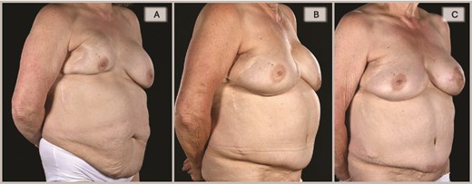 Right oblique views showing the pre-, 6-, and 15-month post-operative appearances: (A) Severely contracted and scarred right breast prior to DIEP reconstruction, (B) 6 months post-DIEP: the flap has provided adequate volume and better IMF definition with dramatic transformation of its appearance, and (C) the symmetry was further improved by a contralateral balancing batwing mastopexy and implant exchange, with notable improvement in overall symmetry (in terms of NAC position, natural-looking upper poles, and overall volume).
