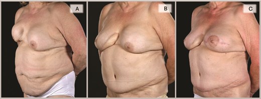 Left oblique views demonstrate the improvement achieved by DIEP reconstruction in correcting the severely deformed, high-riding, and contracted right breast with inferior skin shortage, restoring both volume and skin envelope for improved breast shape, with the inferomedial flap monitoring buoy skin paddle became less noticeable with time (3C) and a subsequent bat-wing mastopexy enabled the alignment of the two NACs (3C).