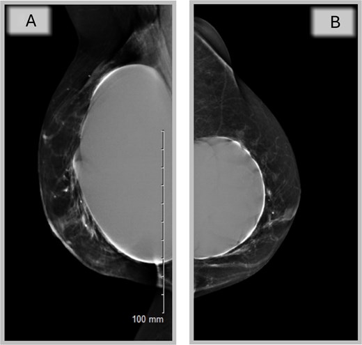 Mammography of the two breasts shows asymmetrical augmentation of the two breasts with no evidence of implant rupture or parenchymal abnormality supporting oncological MDT’s recommendation.