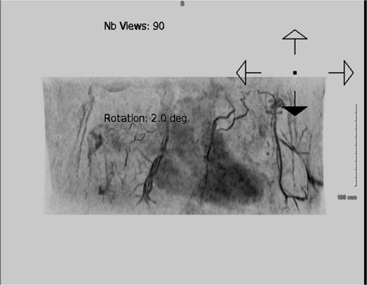 Pre-operative computed tomography (CT) angiography demonstrated robust vasculature perfusing the superior and lateral margins of the right breast, suggesting the planned infero-medial access incision would not de-vascularize the remaining breast tissue.