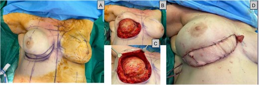 (A) Intraoperative series during DIEP surgery, a: Showing the inferior ellipse of contracted skin to be excised, (B + C) capsule undergoing total capsulectomy with the superior breast tissue still intact (D): Immediately after flap inset showing the monitoring skin paddle.