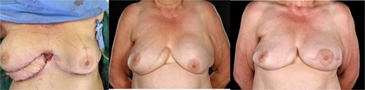 The intraoperative the 6- and 15-month post-operative photos demonstrate the evolution in the appearance of the monitoring paddle, which is finally well incorporated into the contouring of the breast, with most of the DIEP flap deeply buried in the capsulectomy pocket.