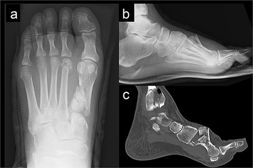 Radiography (a, b) and computed tomography (c) images of the left forefoot showing the comminuted first-metatarsal fracture.