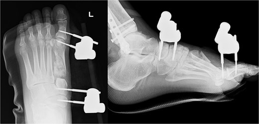 Radiography images immediately after the first surgery.