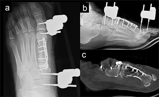 Radiography (a, b) and computed tomography (c) images immediately after the second surgery.