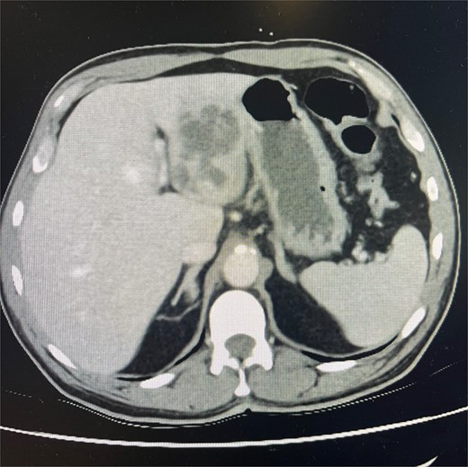 CT abdomen and pelvis in portal venous phase in axial slice. Hepatic abscess seen in left hepatic lobe.