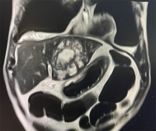 MRI liver in coronal slice. Hepatic abscess seen in left hepatic lobe.