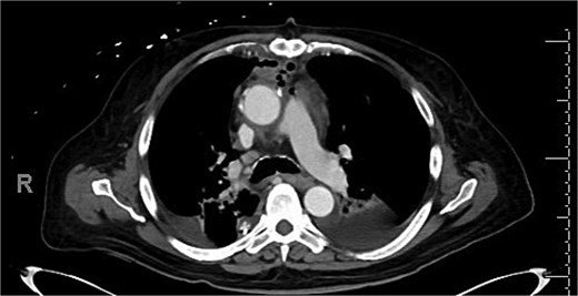 Post operative CT scan concerning for mediastinitis.