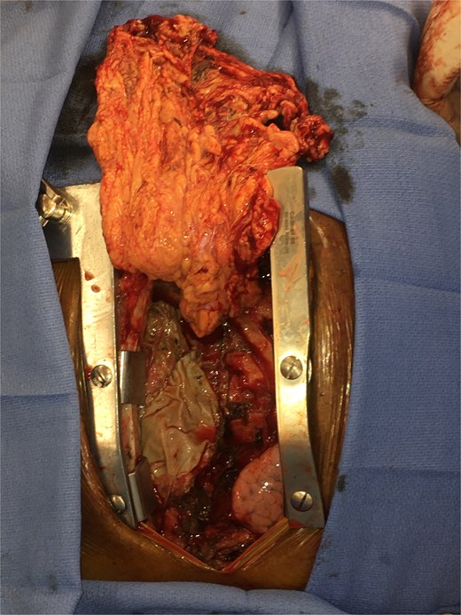 Intra-operative picture of omental flap.