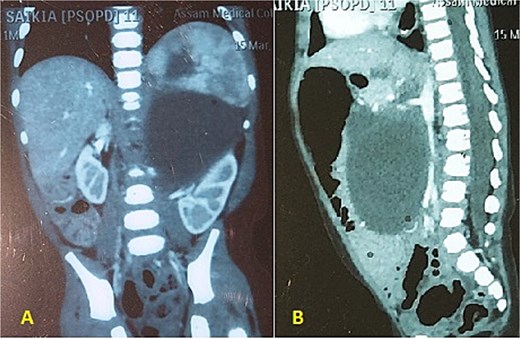 (A, B) CECT abdomen shows multicystic/solid mass pushing the abdominal organs.