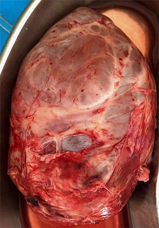 The excised tumour with variable size cysts and solid component.