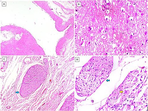 (A) Cystic structure lined by neuroglial tissue (H&E, 40×). (B) Glial tissue (H&E, 400×). (C) Nerve trunks (blue arrow) (H&E, 100×). (D) Nerve trunks (blue arrow) and ganglion cells (yellow arrow) (H&E, 400×).