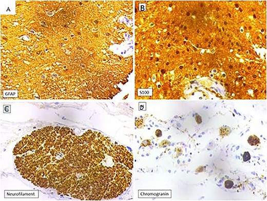 (A) Glial tissue showing GFAP positivity (IHC, 400×). (B) Glial tissue showing S100 positivity (IHC, 400×). (C) Nerve trunk showing neurofilament positivity (IHC, 100×). (D) Ganglion cells showing chromogranin positivity (IHC, 400×).