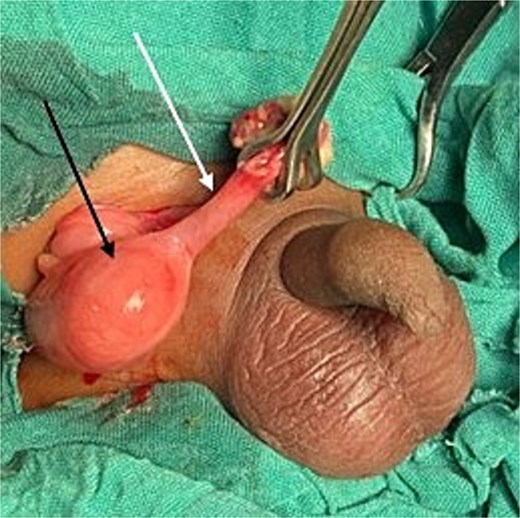 Intraoperative view of Amyand’s hernia. Black arrow: cecum; white arrow: inflamed appendix.