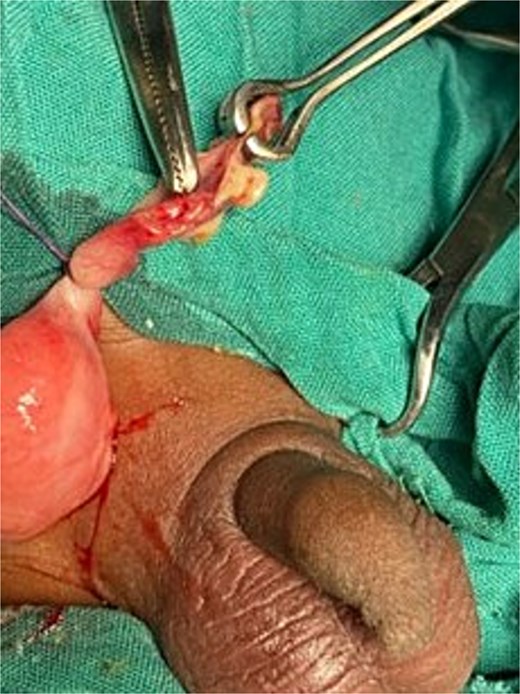 Intraoperative view of perforated appendix.